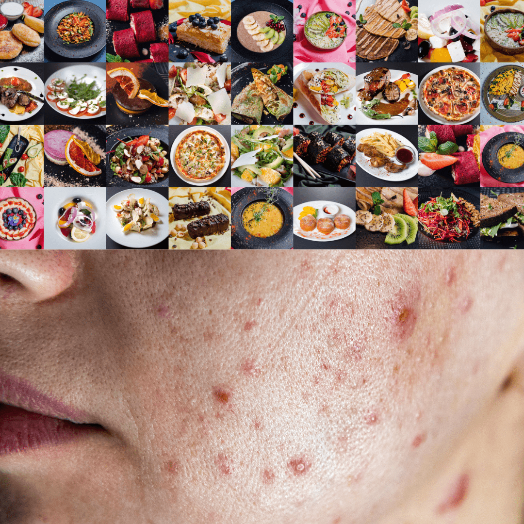 Top 5 Acne-Triggering Foods: Whey Protein, Fried Foods, Sugar, Dairy & White Bread - Dude-Skin